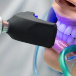 Sbiancamento-professionale-dei-denti-durata-e-fasi-operative-1140x640